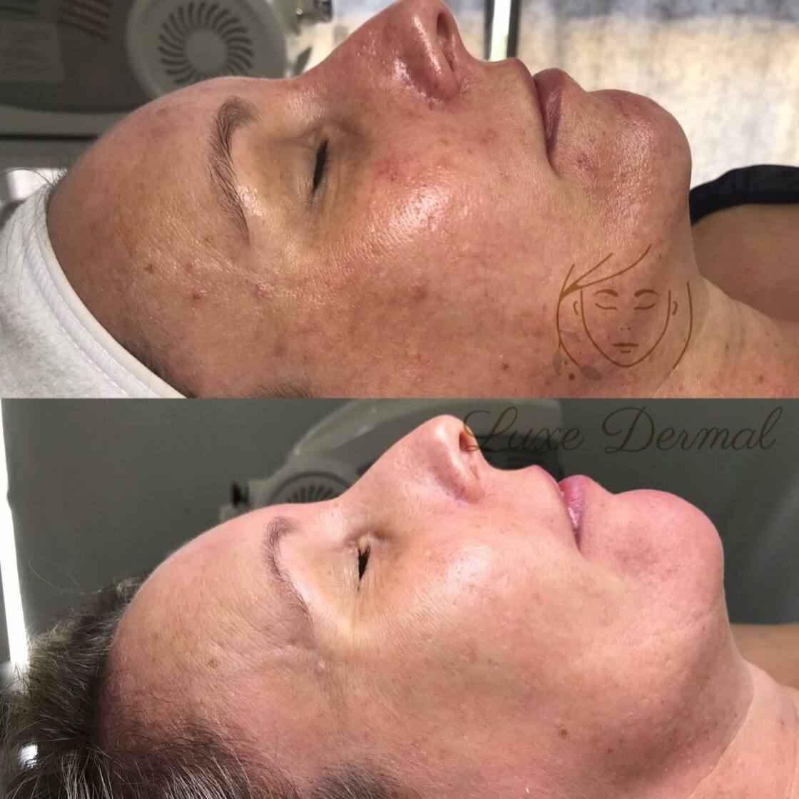 Skin Tightening and Non-Surgical Facelift - Glow Luxe – Glow Luxe